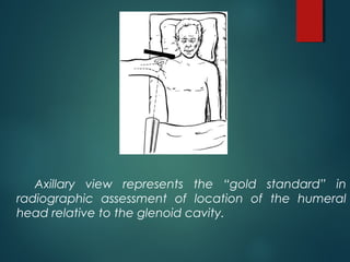 Axillary view represents the “gold standard” in 
radiographic assessment of location of the humeral 
head relative to the glenoid cavity. 
 