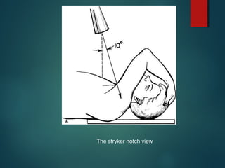 The stryker notch view 
 