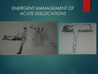 EMERGENT MANAGEMENT OF 
ACUTE DISLOCATIONS 
 