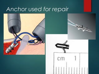Anchor used for repair 
 