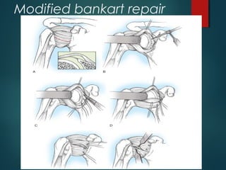Modified bankart repair 
 
