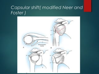 Capsular shift( modified Neer and 
Foster ) 
 