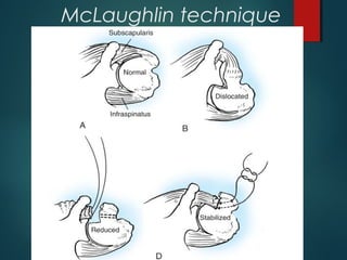 McLaughlin technique 
 subscapularis 
 