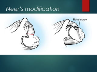 Neer’s modification 
 