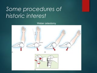 Some procedures of 
historic interest 
Weber osteotomy 
 