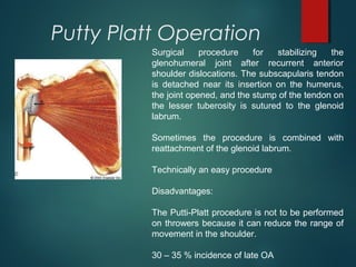Putty Platt Operation 
Surgical procedure for stabilizing the 
glenohumeral joint after recurrent anterior 
shoulder dislocations. The subscapularis tendon 
is detached near its insertion on the humerus, 
the joint opened, and the stump of the tendon on 
the lesser tuberosity is sutured to the glenoid 
labrum. 
Sometimes the procedure is combined with 
reattachment of the glenoid labrum. 
Technically an easy procedure 
Disadvantages: 
The Putti-Platt procedure is not to be performed 
on throwers because it can reduce the range of 
movement in the shoulder. 
30 – 35 % incidence of late OA 
 