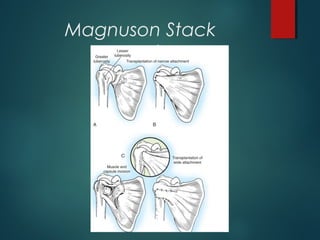 Magnuson Stack 
procedure 
 