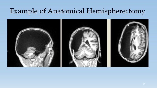 When One Hemisphere Innervates Both Sides Of The Body