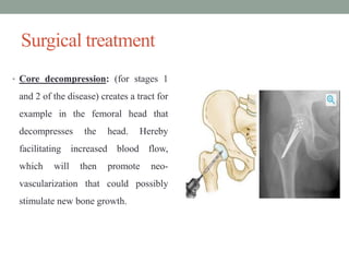 AVN Of Hip.pptx
