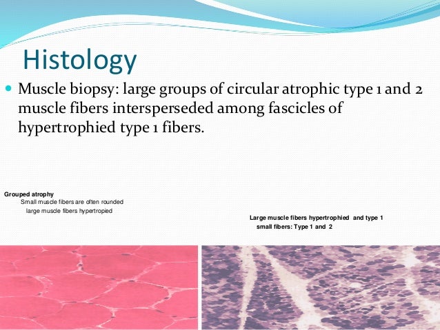SPINAL MUSCULAR ATROPY