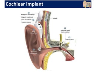 Cochlear implant
 
