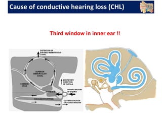 Cause of conductive hearing loss (CHL)
Third window in inner ear !!
 