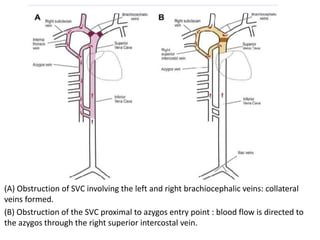 Svc Compression Sign Final superior vena cava syndrome .pptx