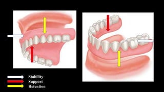 Support Stability Retention Rpd Final support | PPTX