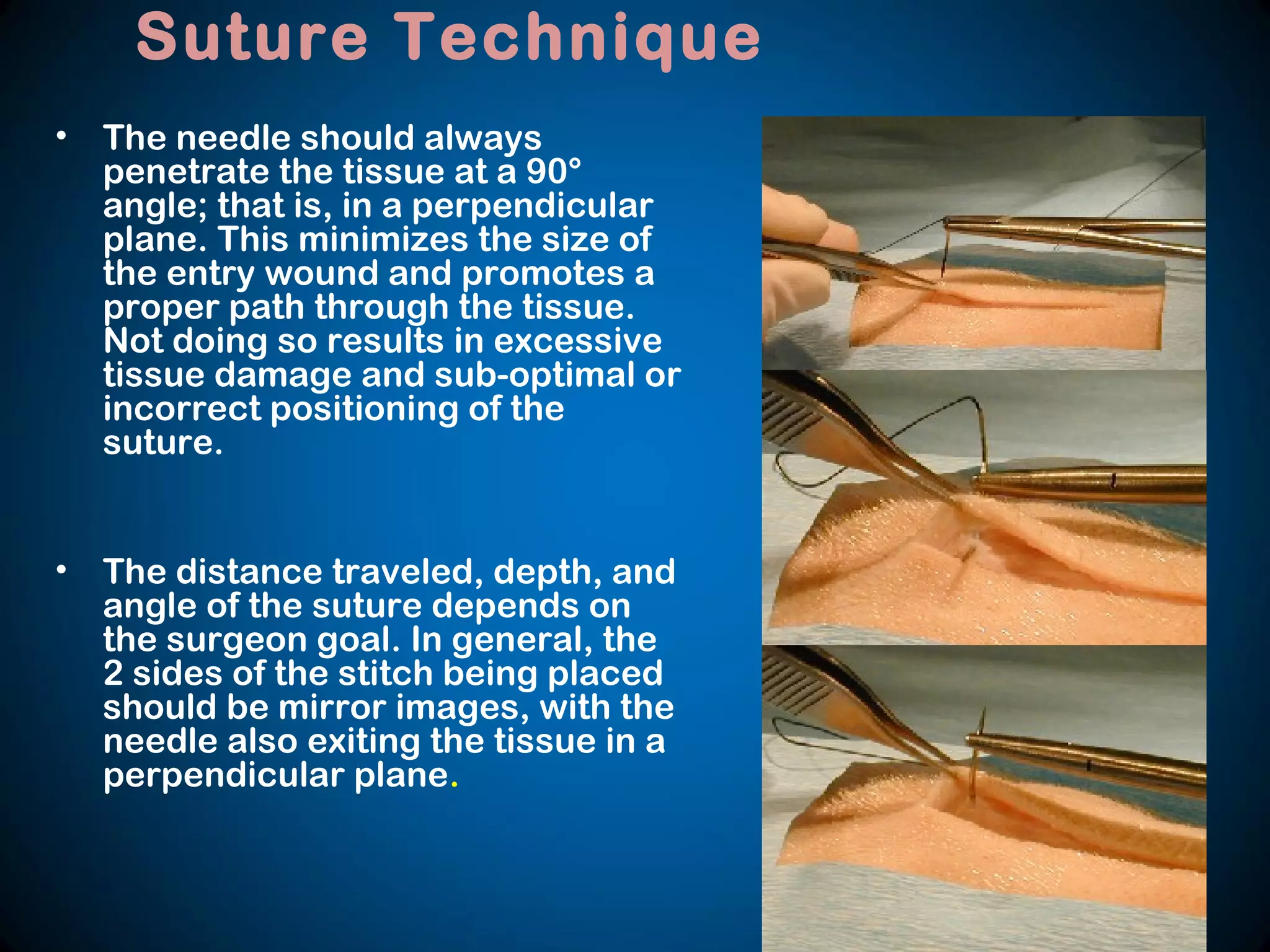 • The needle should always
penetrate the tissue at a 90°
angle; that is, in a perpendicular
plane. This minimizes the size of
the entry wound and promotes a
proper path through the tissue.
Not doing so results in excessive
tissue damage and sub-optimal or
incorrect positioning of the
suture.
• The distance traveled, depth, and
angle of the suture depends on
the surgeon goal. In general, the
2 sides of the stitch being placed
should be mirror images, with the
needle also exiting the tissue in a
perpendicular plane.
Suture Technique
 
