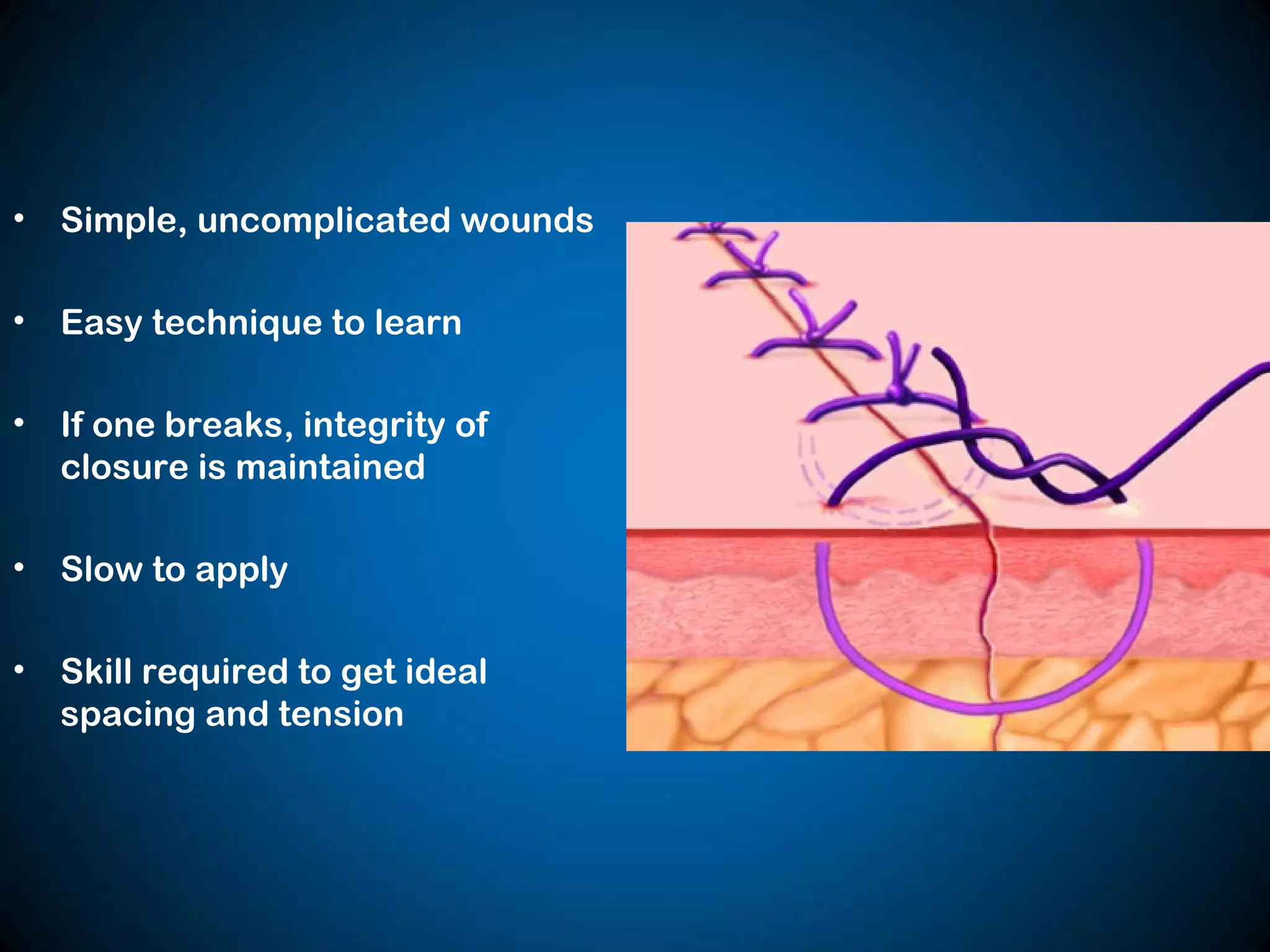 • Simple, uncomplicated wounds
• Easy technique to learn
• If one breaks, integrity of
closure is maintained
• Slow to apply
• Skill required to get ideal
spacing and tension
 