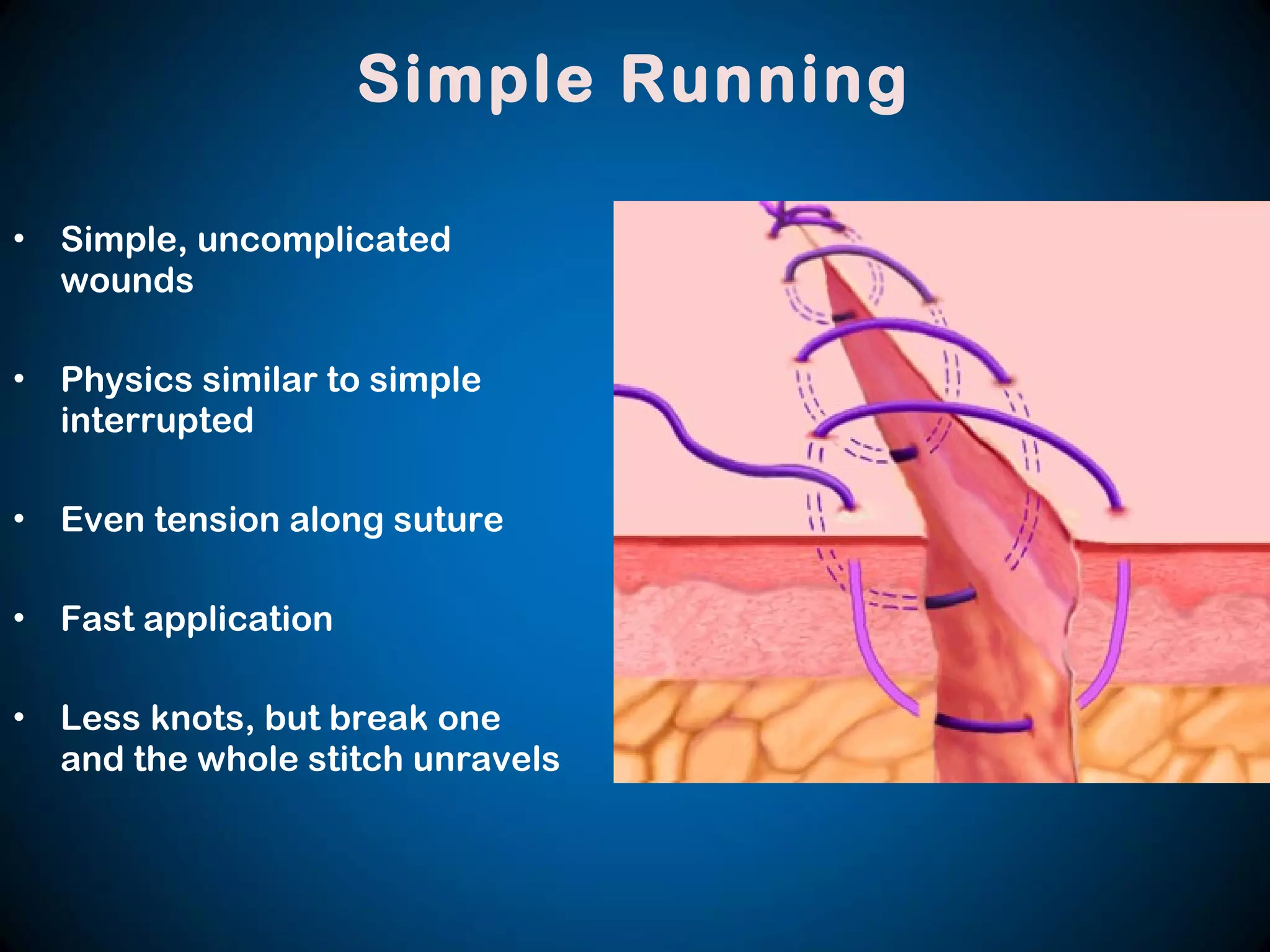 • Simple, uncomplicated
wounds
• Physics similar to simple
interrupted
• Even tension along suture
• Fast application
• Less knots, but break one
and the whole stitch unravels
Simple Running
 