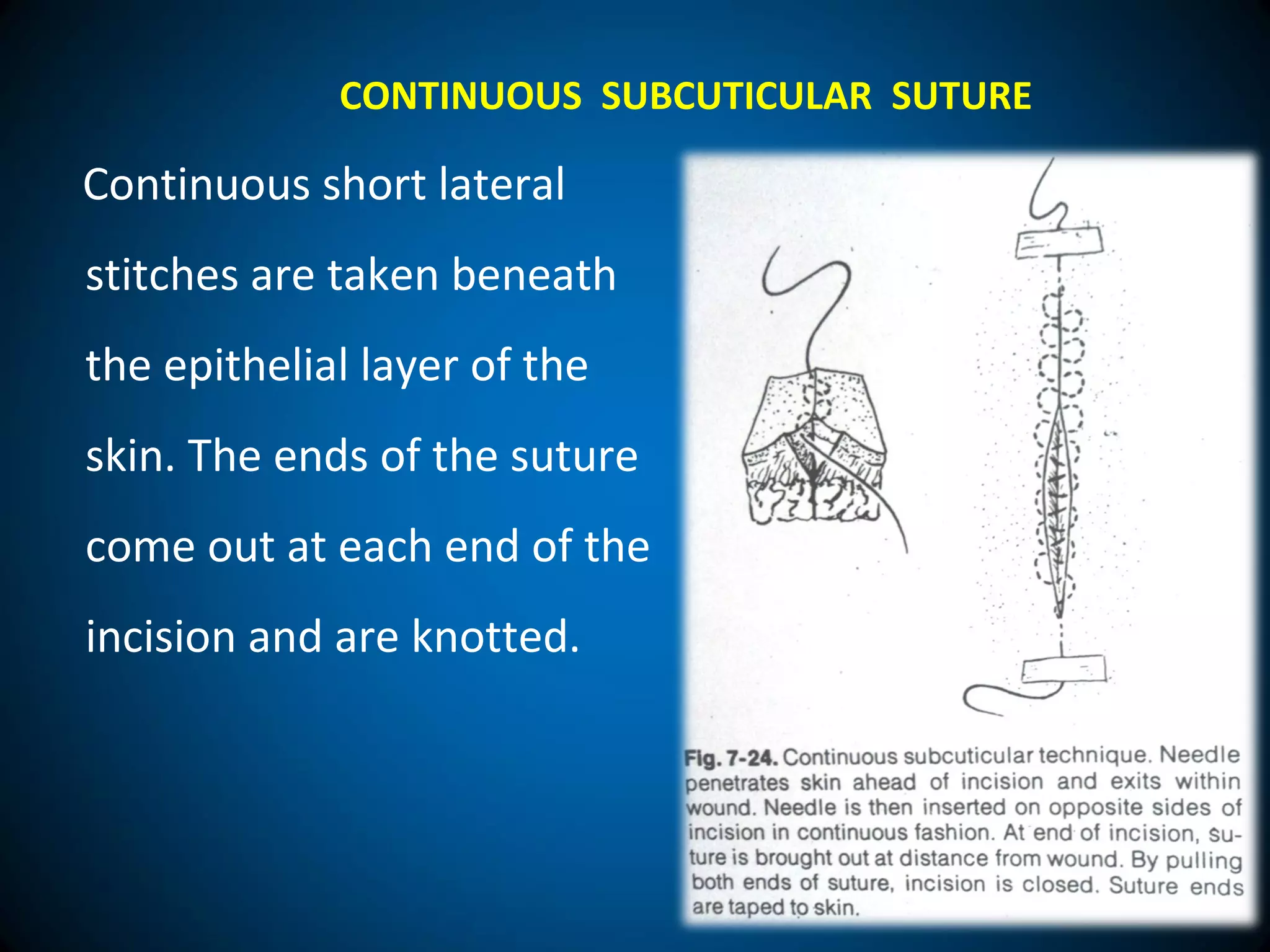 Continuous short lateral
stitches are taken beneath
the epithelial layer of the
skin. The ends of the suture
come out at each end of the
incision and are knotted.
CONTINUOUS SUBCUTICULAR SUTURE
 
