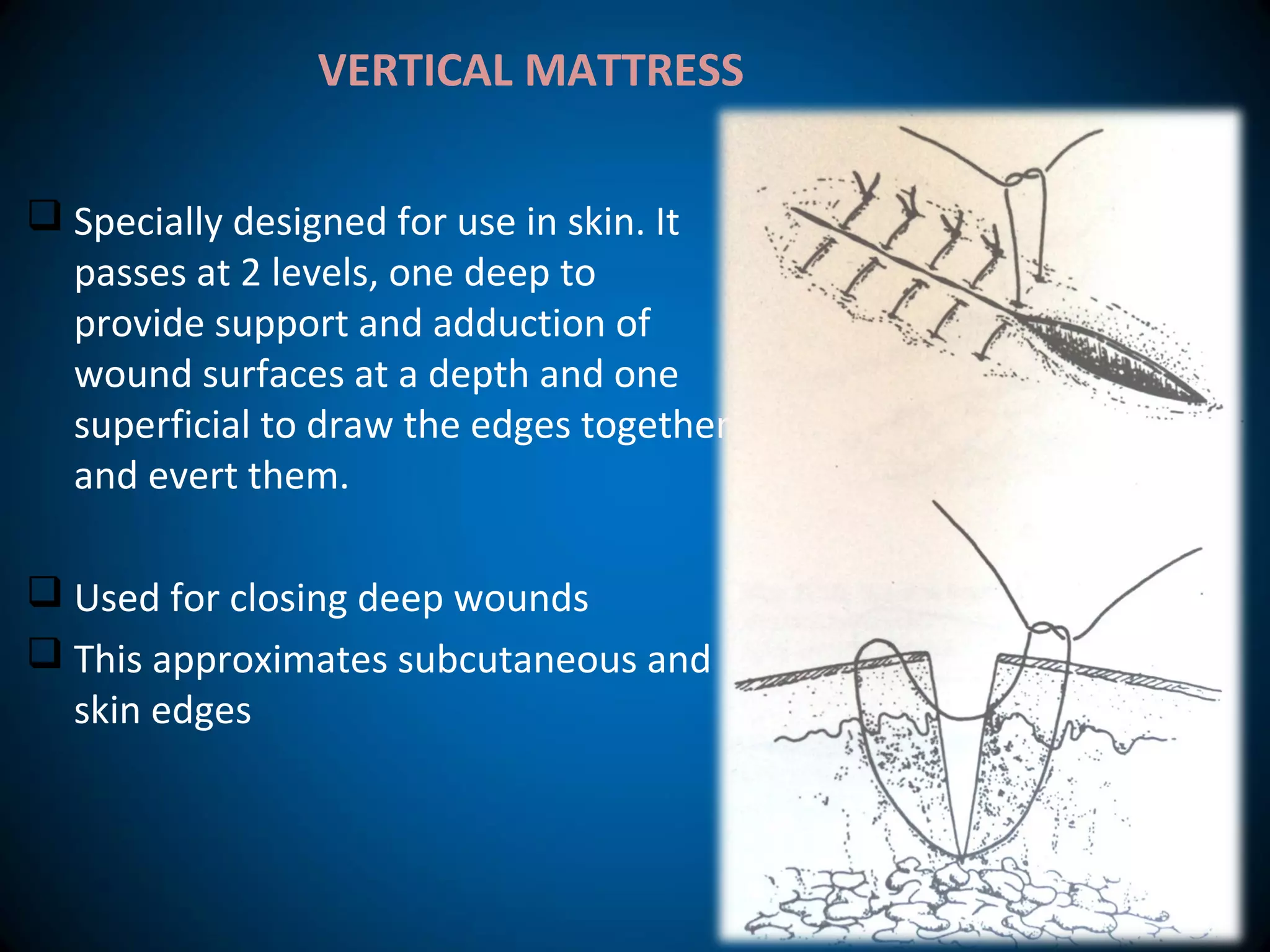  Specially designed for use in skin. It
passes at 2 levels, one deep to
provide support and adduction of
wound surfaces at a depth and one
superficial to draw the edges together
and evert them.
 Used for closing deep wounds
 This approximates subcutaneous and
skin edges
VERTICAL MATTRESS
 