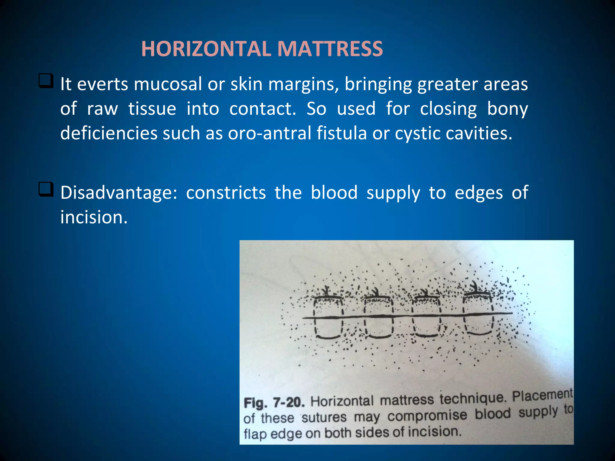  It everts mucosal or skin margins, bringing greater areas
of raw tissue into contact. So used for closing bony
deficiencies such as oro-antral fistula or cystic cavities.
 Disadvantage: constricts the blood supply to edges of
incision.
HORIZONTAL MATTRESS
 