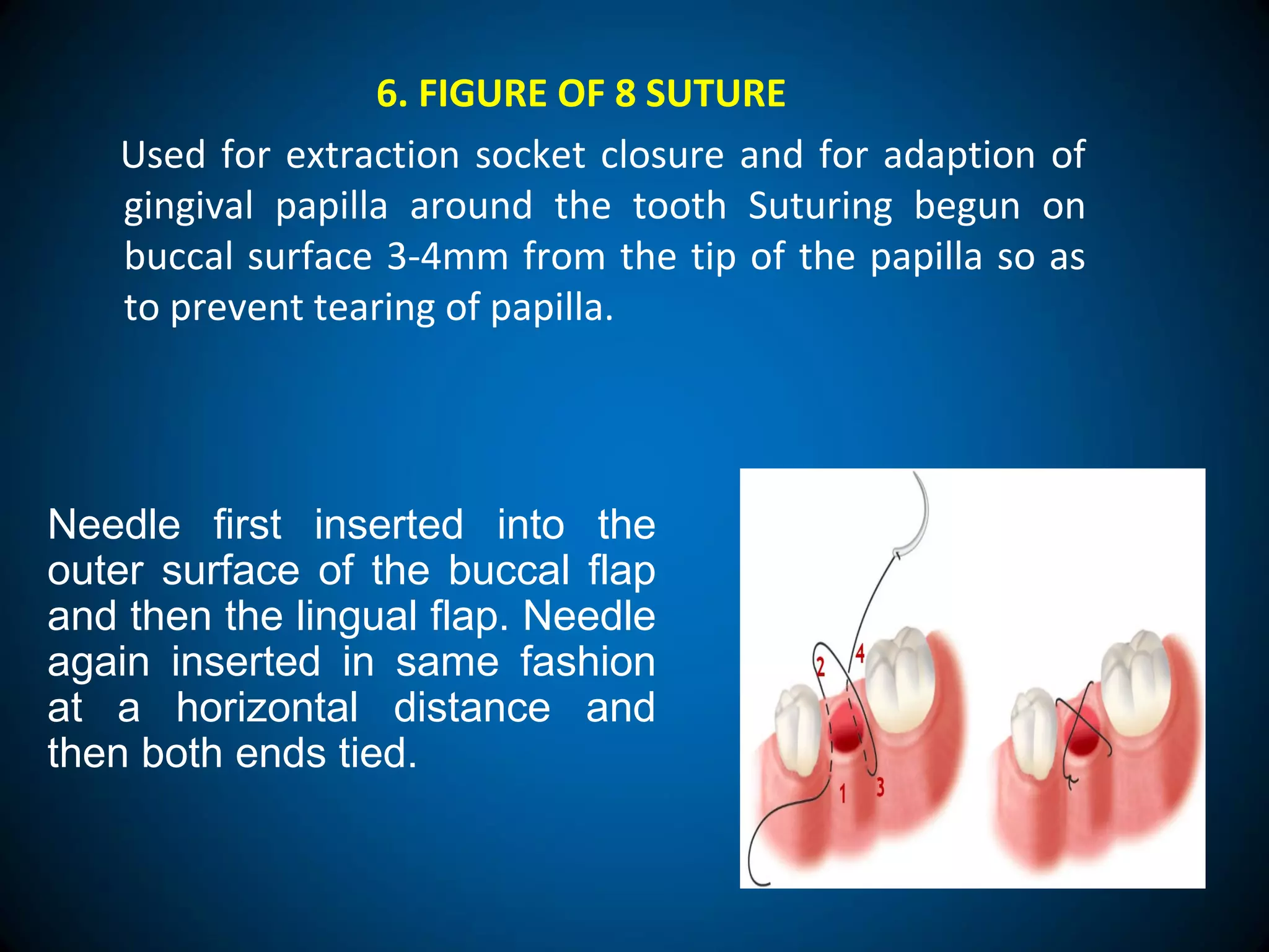6. FIGURE OF 8 SUTURE
Used for extraction socket closure and for adaption of
gingival papilla around the tooth Suturing begun on
buccal surface 3-4mm from the tip of the papilla so as
to prevent tearing of papilla.
Needle first inserted into the
outer surface of the buccal flap
and then the lingual flap. Needle
again inserted in same fashion
at a horizontal distance and
then both ends tied.
 