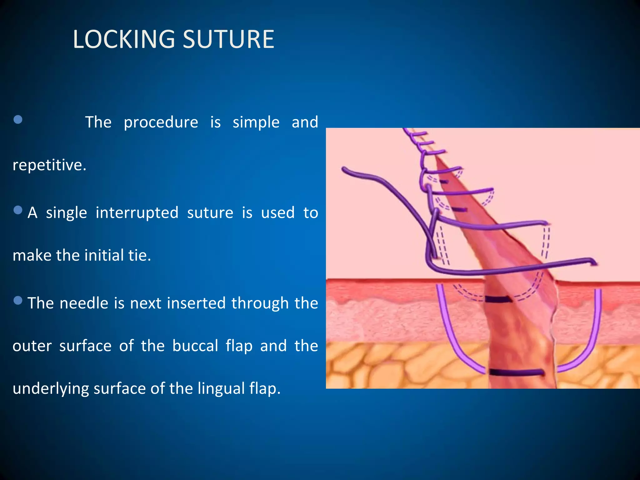 LOCKING SUTURE
 The procedure is simple and
repetitive.
A single interrupted suture is used to
make the initial tie.
The needle is next inserted through the
outer surface of the buccal flap and the
underlying surface of the lingual flap.
 