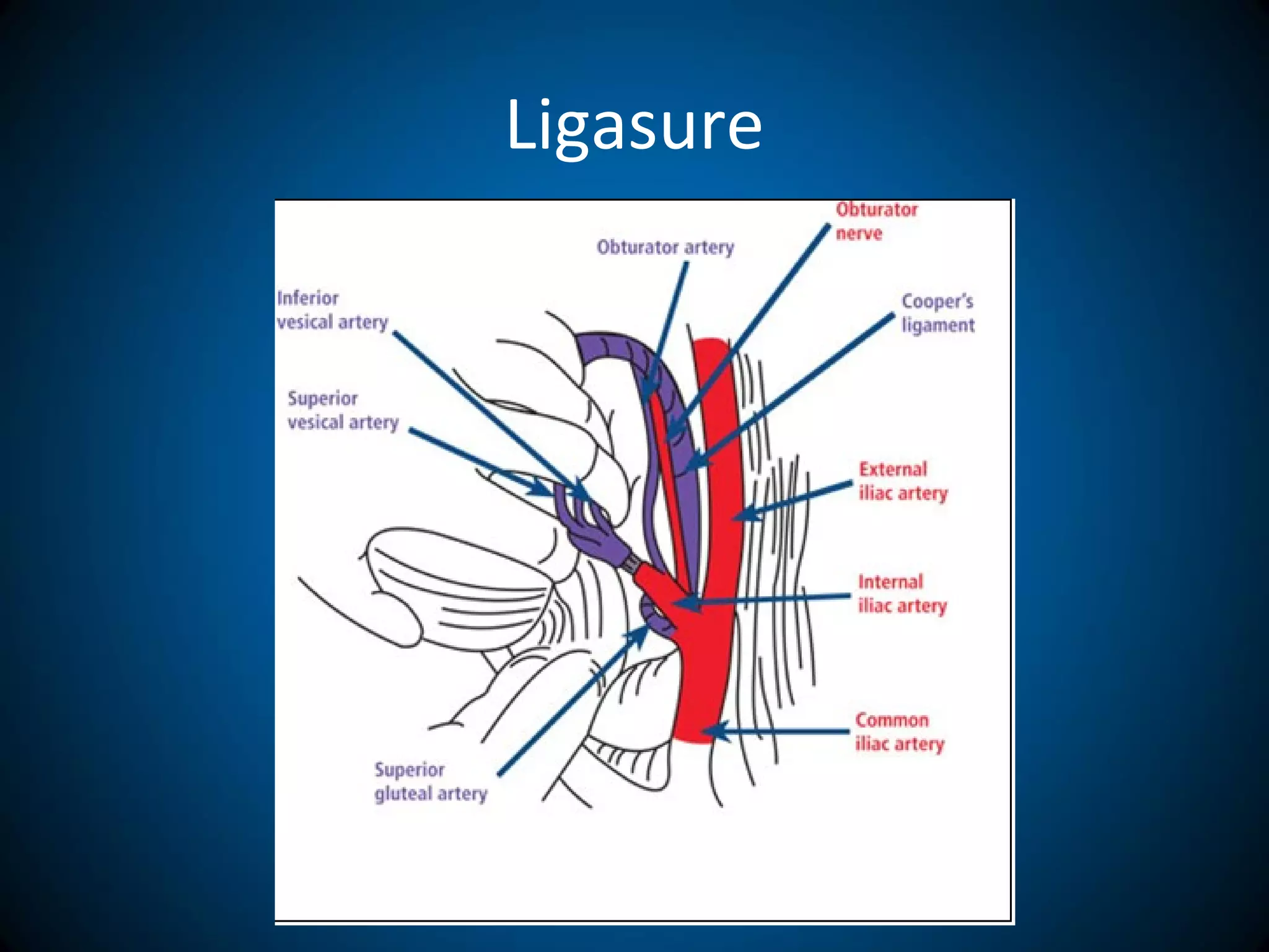 Ligasure
 