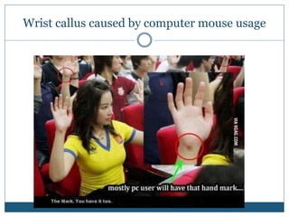 Wrist callus caused by computer mouse usage
 