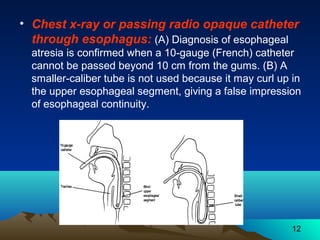 12
• Chest x-ray or passing radio opaque catheter
through esophagus: (A) Diagnosis of esophageal
atresia is confirmed when a 10-gauge (French) catheter
cannot be passed beyond 10 cm from the gums. (B) A
smaller-caliber tube is not used because it may curl up in
the upper esophageal segment, giving a false impression
of esophageal continuity.
 