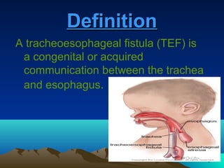 3
DefinitionDefinition
A tracheoesophageal fistula (TEF) is
a congenital or acquired
communication between the trachea
and esophagus.
 