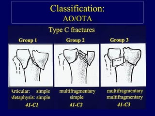 EBM - Tibial Plateau Fractures - Dr.Chintan N. Patel | PPT