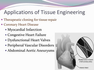 Applications of Tissue Engineering
 Therapeutic cloning for tissue repair
 Coronary Heart Disease
   Myocardial Infarction
   Congestive Heart Failure
   Dysfunctional Heart Valves
   Peripheral Vascular Disorders
   Abdominal Aortic Aneurysms
 