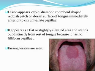 Lesion appears ovoid, diamond rhomboid shaped
reddish patch on dorsal surface of tongue immediately
anterior to circumvallate papillae.
It appears as a flat or slightyly elevated area and stands
out distinctly from rest of tongue because it has no
filliform papillae .
Kissing lesions are seen.
 