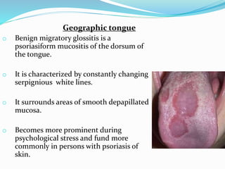 Geographic tongue
o Benign migratory glossitis is a
psoriasiform mucositis of the dorsum of
the tongue.
o It is characterized by constantly changing
serpignious white lines.
o It surrounds areas of smooth depapillated
mucosa.
o Becomes more prominent during
psychological stress and fund more
commonly in persons with psoriasis of
skin.
 