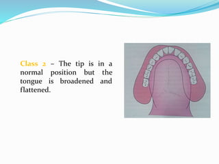 Class 2 – The tip is in a
normal position but the
tongue is broadened and
flattened.
 