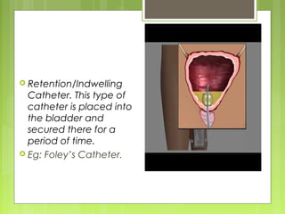 Final urinary bladder catheterisation | PPT