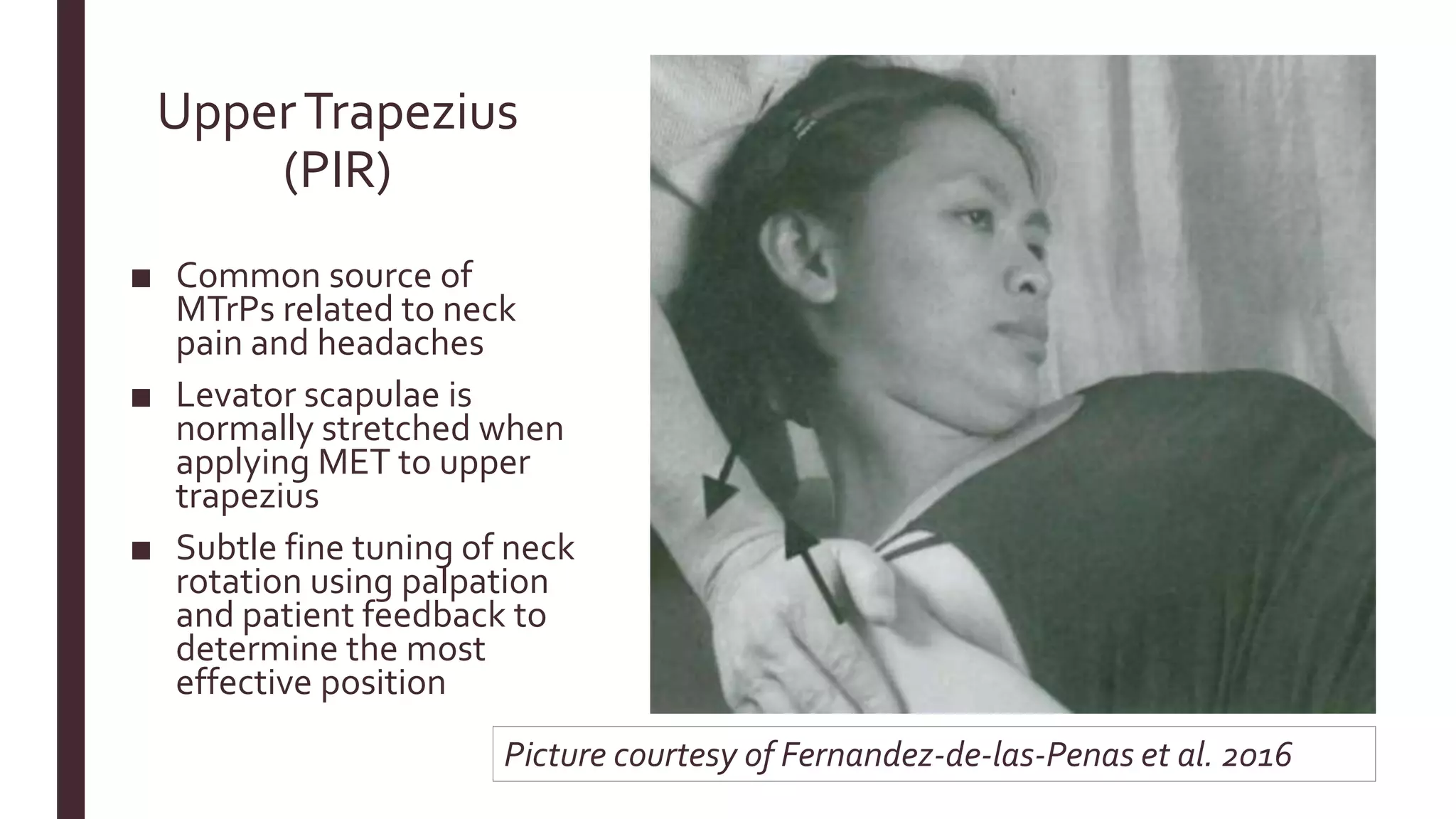 UpperTrapezius
(PIR)
■ Common source of
MTrPs related to neck
pain and headaches
■ Levator scapulae is
normally stretched when
applying MET to upper
trapezius
■ Subtle fine tuning of neck
rotation using palpation
and patient feedback to
determine the most
effective position
Picture courtesy of Fernandez-de-las-Penas et al. 2016
 