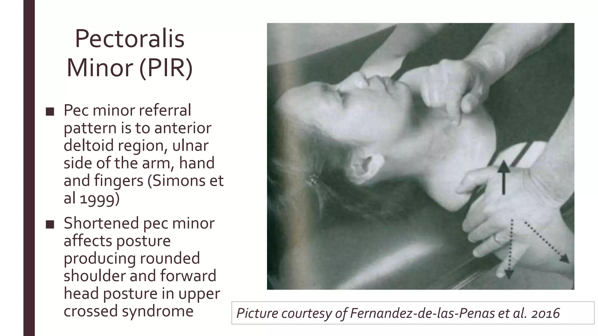 Pectoralis
Minor (PIR)
■ Pec minor referral
pattern is to anterior
deltoid region, ulnar
side of the arm, hand
and fingers (Simons et
al 1999)
■ Shortened pec minor
affects posture
producing rounded
shoulder and forward
head posture in upper
crossed syndrome Picture courtesy of Fernandez-de-las-Penas et al. 2016
 