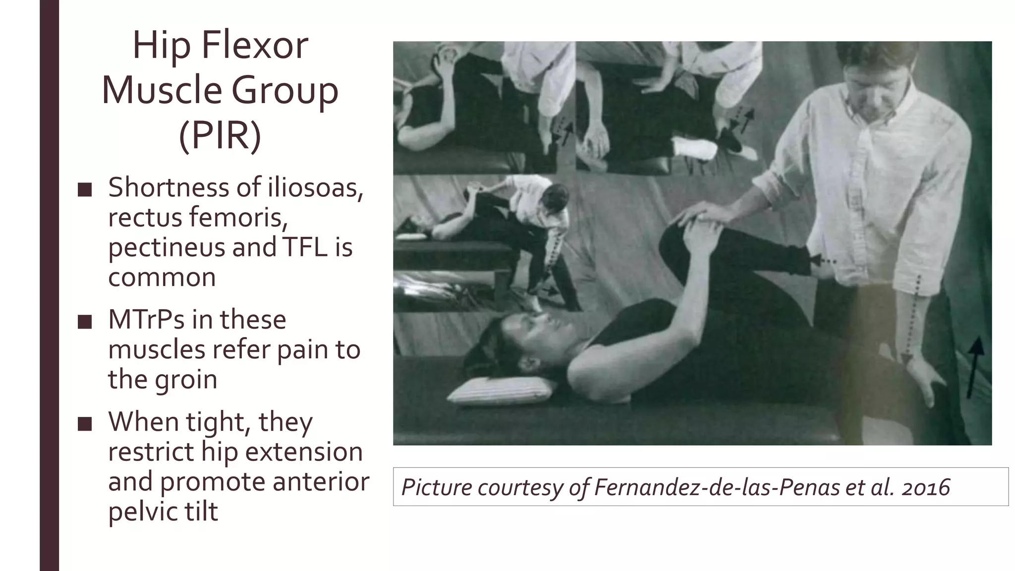 Hip Flexor
Muscle Group
(PIR)
■ Shortness of iliosoas,
rectus femoris,
pectineus andTFL is
common
■ MTrPs in these
muscles refer pain to
the groin
■ When tight, they
restrict hip extension
and promote anterior
pelvic tilt
Picture courtesy of Fernandez-de-las-Penas et al. 2016
 