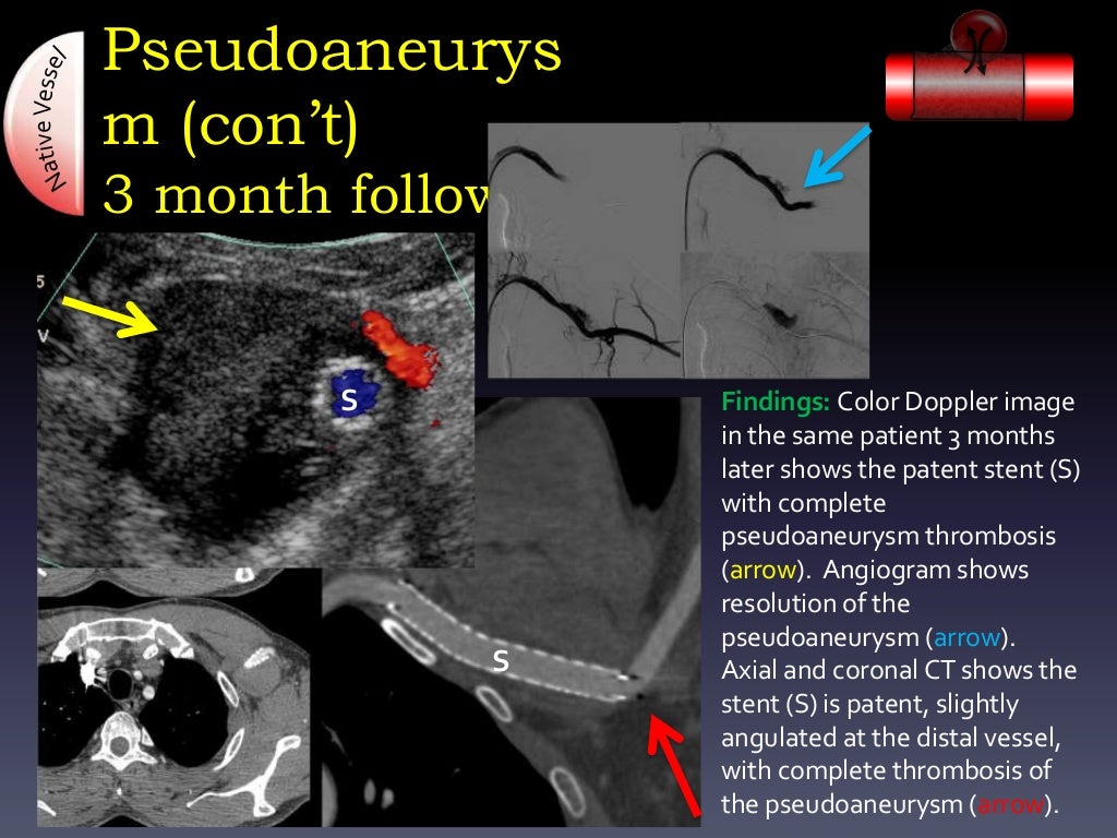 Ultrasound Arterial Stent Complications by Ali Mian Yale Universit…