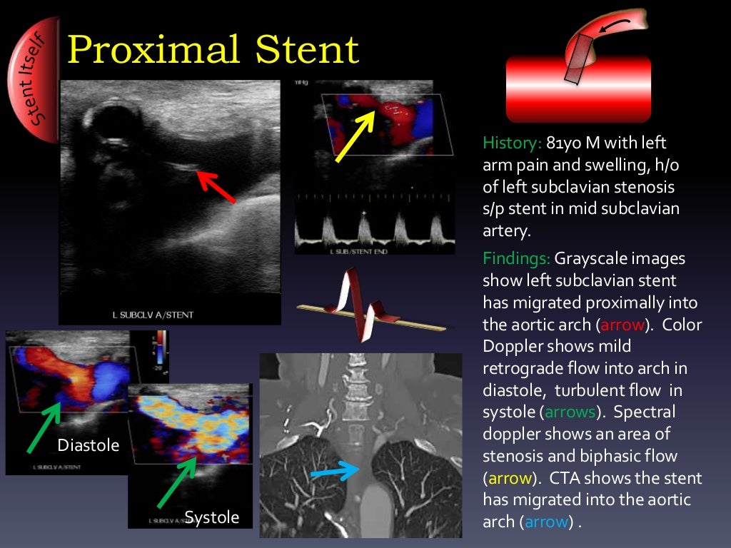 Ultrasound Arterial Stent Complications by Ali Mian Yale Universit…