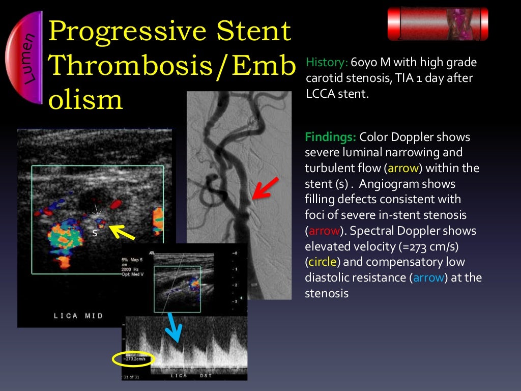 Ultrasound Arterial Stent Complications by Ali Mian Yale Universit…