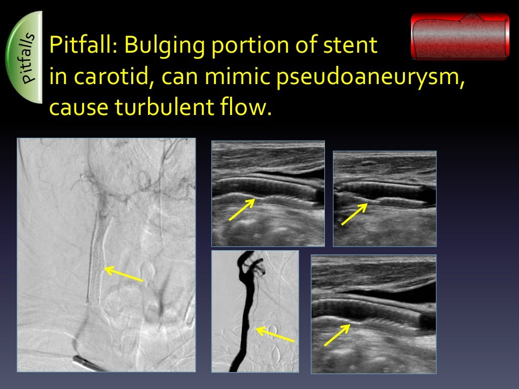 Ultrasound Arterial Stent Complications by Ali Mian Yale Universit…