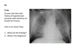 01
X ray
55 year old male with
history of hypertension
presents with shortness of
breath for 6 hours.
Here is his chest X Ray
1. What are the findings?
2. What is the diagnosis?
 