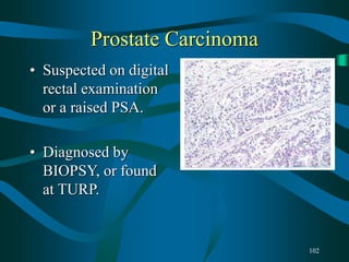 102
Prostate Carcinoma
• Suspected on digital
rectal examination
or a raised PSA.
• Diagnosed by
BIOPSY, or found
at TURP.
 