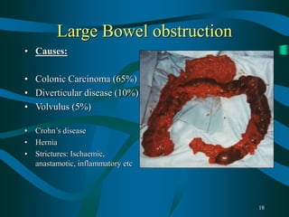 18
Large Bowel obstruction
• Causes:
• Colonic Carcinoma (65%)
• Diverticular disease (10%)
• Volvulus (5%)
• Crohn’s disease
• Hernia
• Strictures: Ischaemic,
anastamotic, inflammatory etc
 