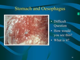 38
Stomach and Oesophagus
• Difficult
Question
• How would
you see this?
• What is it?
 