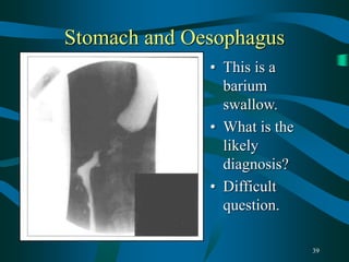 39
Stomach and Oesophagus
• This is a
barium
swallow.
• What is the
likely
diagnosis?
• Difficult
question.
 