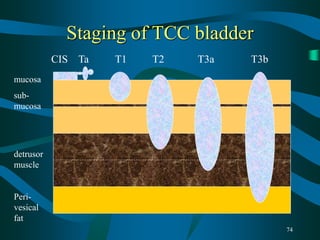74
Staging of TCC bladder
CIS Ta T1 T2 T3a T3b
mucosa
sub-
mucosa
detrusor
muscle
Peri-
vesical
fat
 
