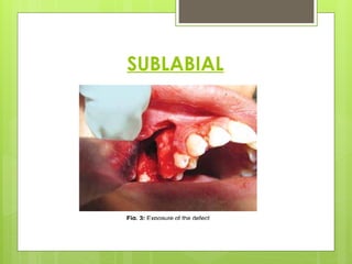 Sublabial Excision Oro-antral Communications and its management strategies | PPTX